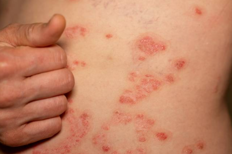 제목 : “흔한 주사 ‘한 방’에 살이 울긋불긋”…불과 ‘한 시간’ 만에 영영 떠난 아빠, 그 이후